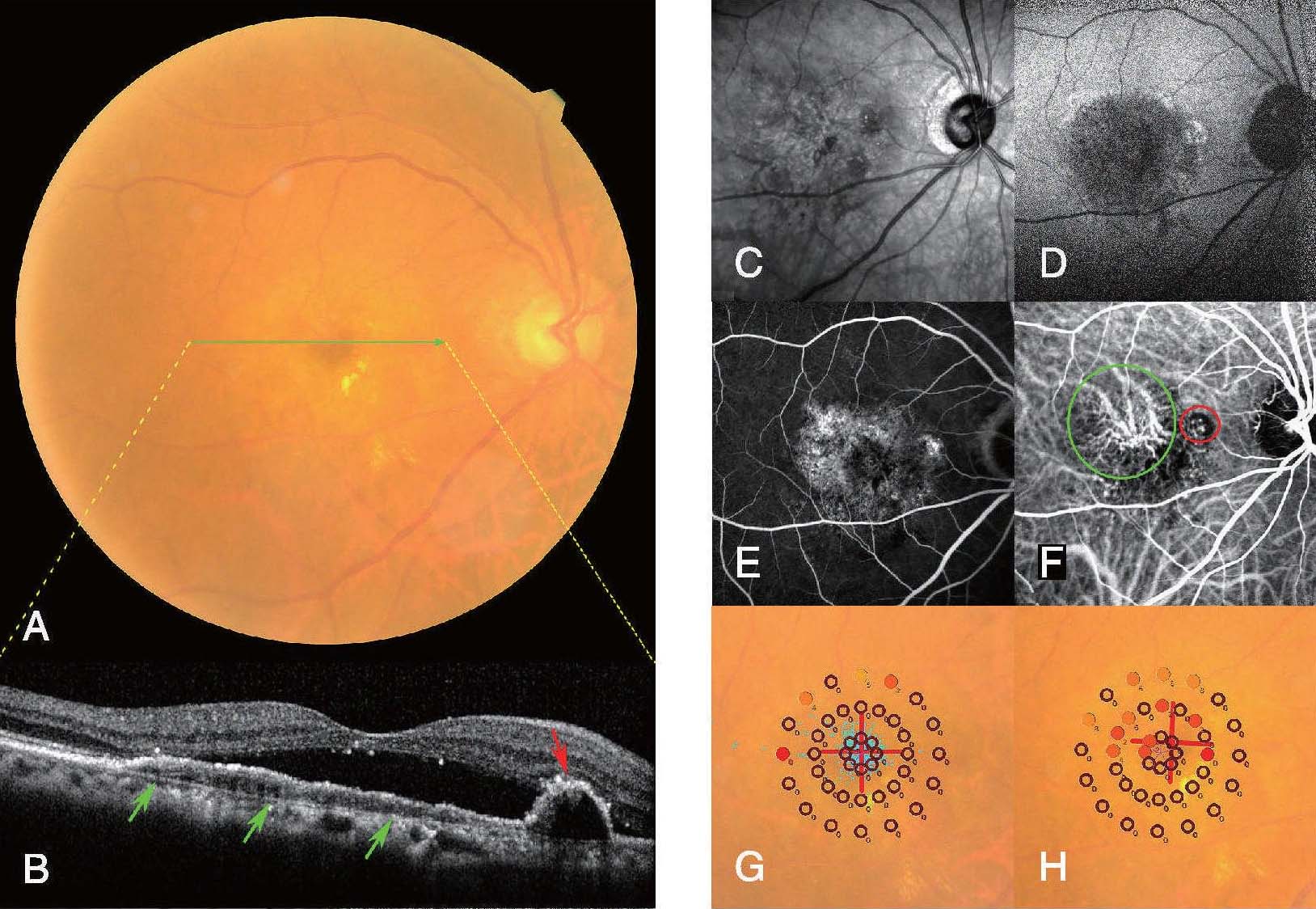 病例2-2-8 診斷:右眼息肉樣脈絡(luò)膜血管病變(polypoidal choroidal vasculopathy，PCV)。